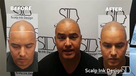 colmek+smp|Miami Scalp Micropigmentation 